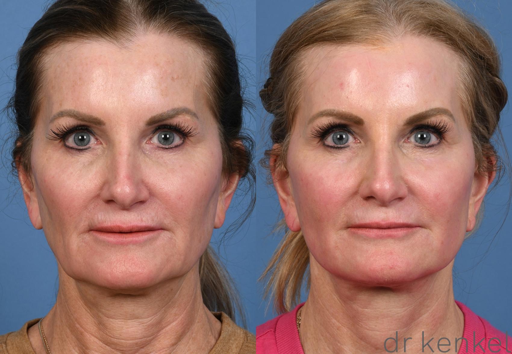 Before & After Facelift Case 380 Front View in Dallas, Frisco, McKinney, Prosper, Allen, Celina, Denton, Anna, TX