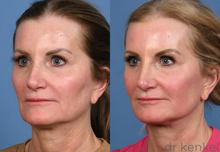 Before & After Facelift Case 380 Left Oblique View in Dallas, Frisco, McKinney, Prosper, Allen, Celina, Denton, Anna, TX
