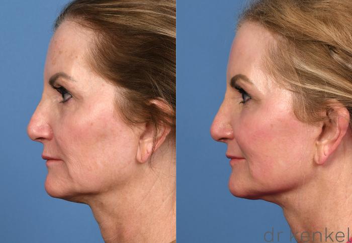 Before & After Facelift Case 380 Left Side View in Dallas, Frisco, McKinney, Prosper, Allen, Celina, Denton, Anna, TX
