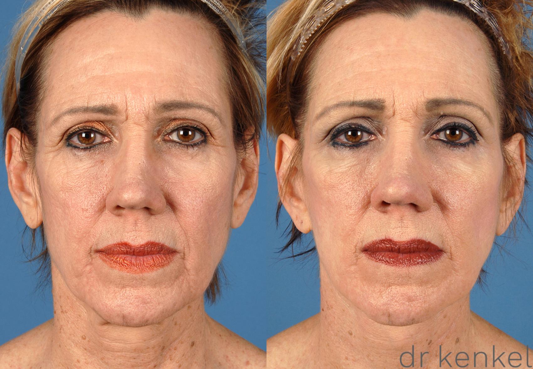 Before & After Facelift Case 47 View #2 View in Dallas, TX