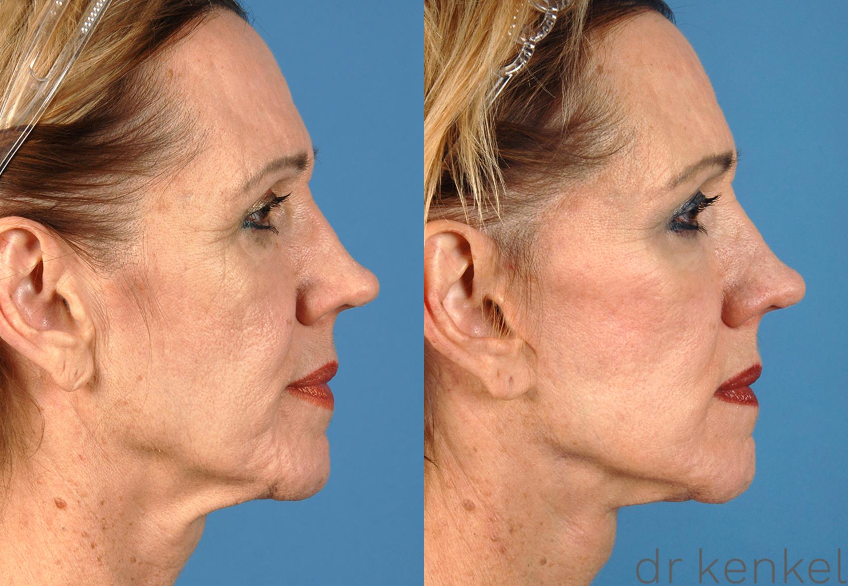 Before & After Facelift Case 47 View #3 View in Dallas, TX