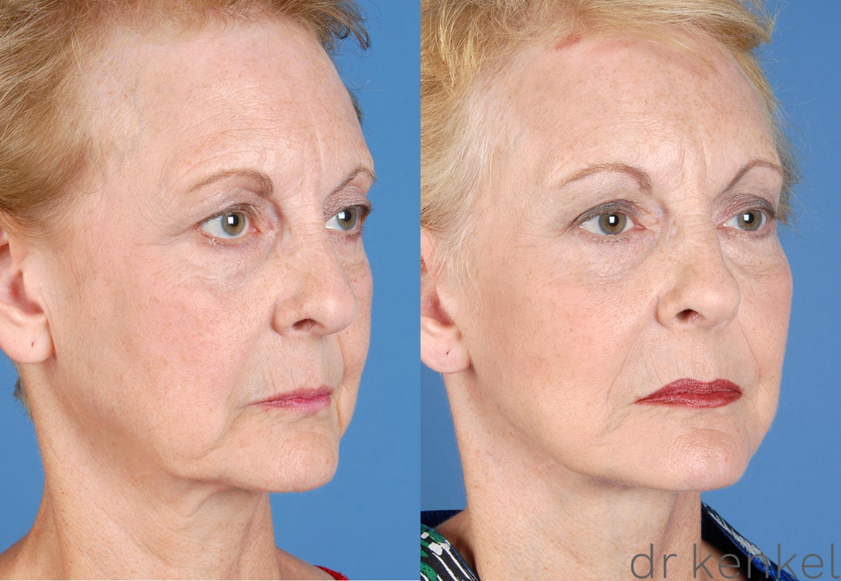 Before & After Facelift Case 51 View #1 View in Dallas, TX