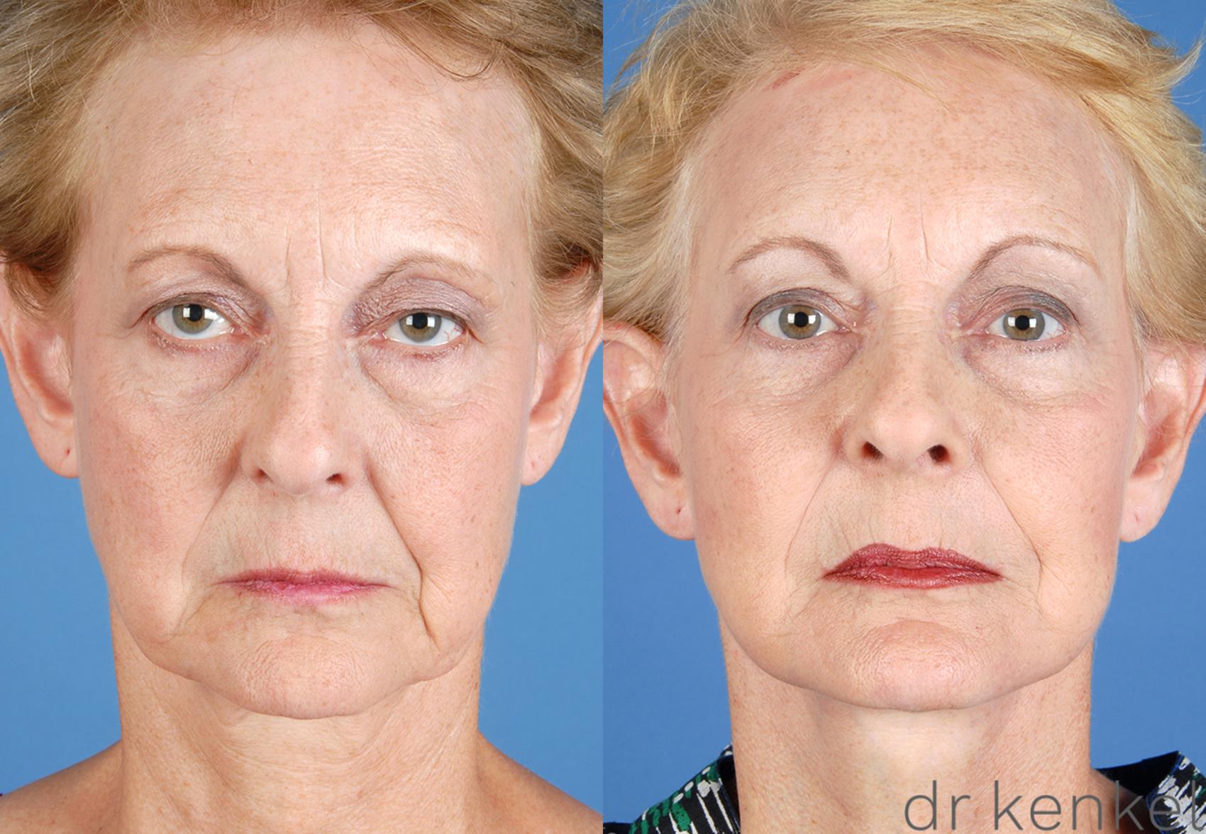 Before & After Facelift Case 51 View #2 View in Dallas, TX