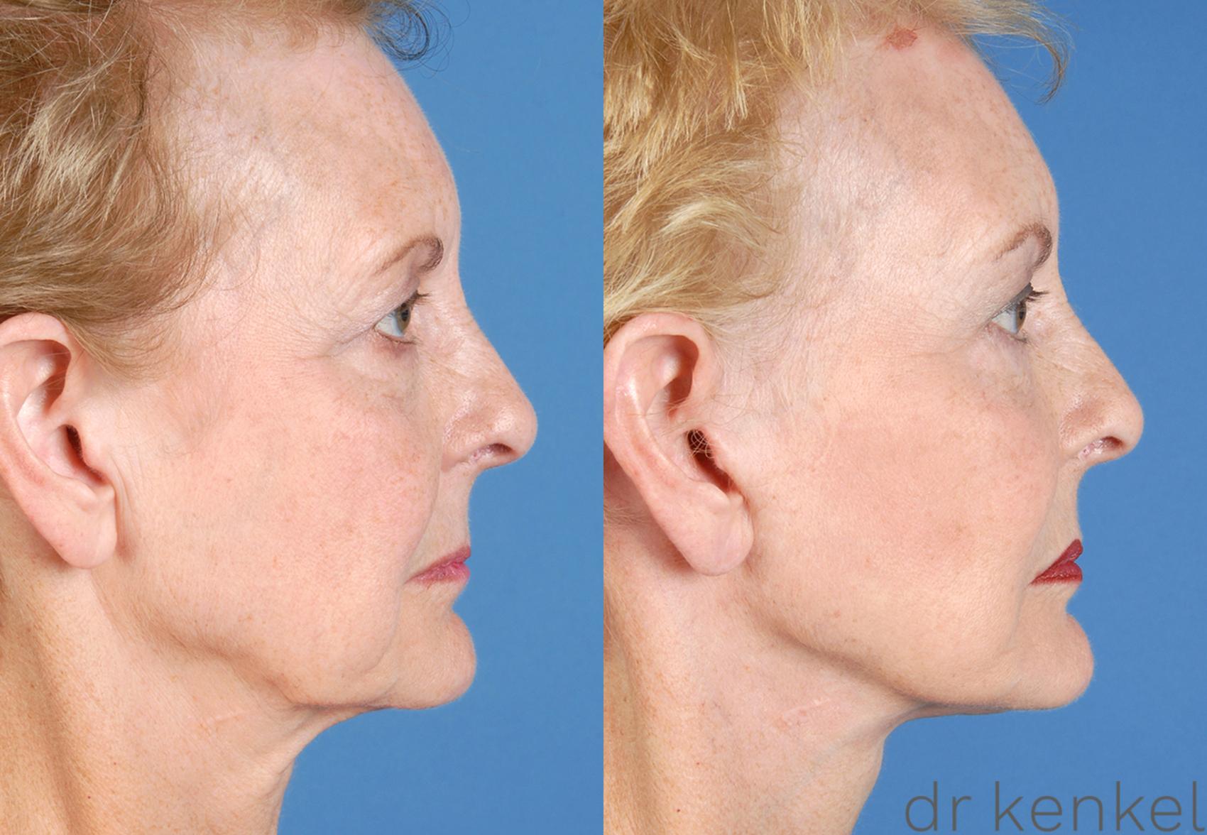 Before & After Facelift Case 51 View #3 View in Dallas, TX