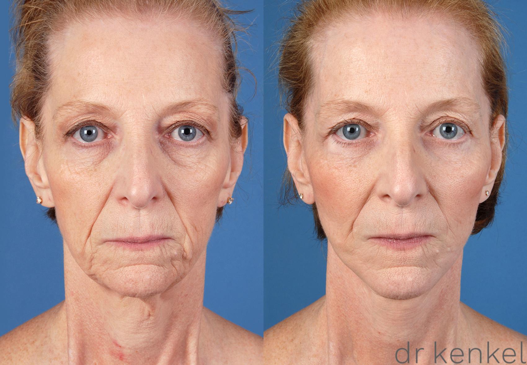 Before & After Facelift Case 52 View #2 View in Dallas, TX