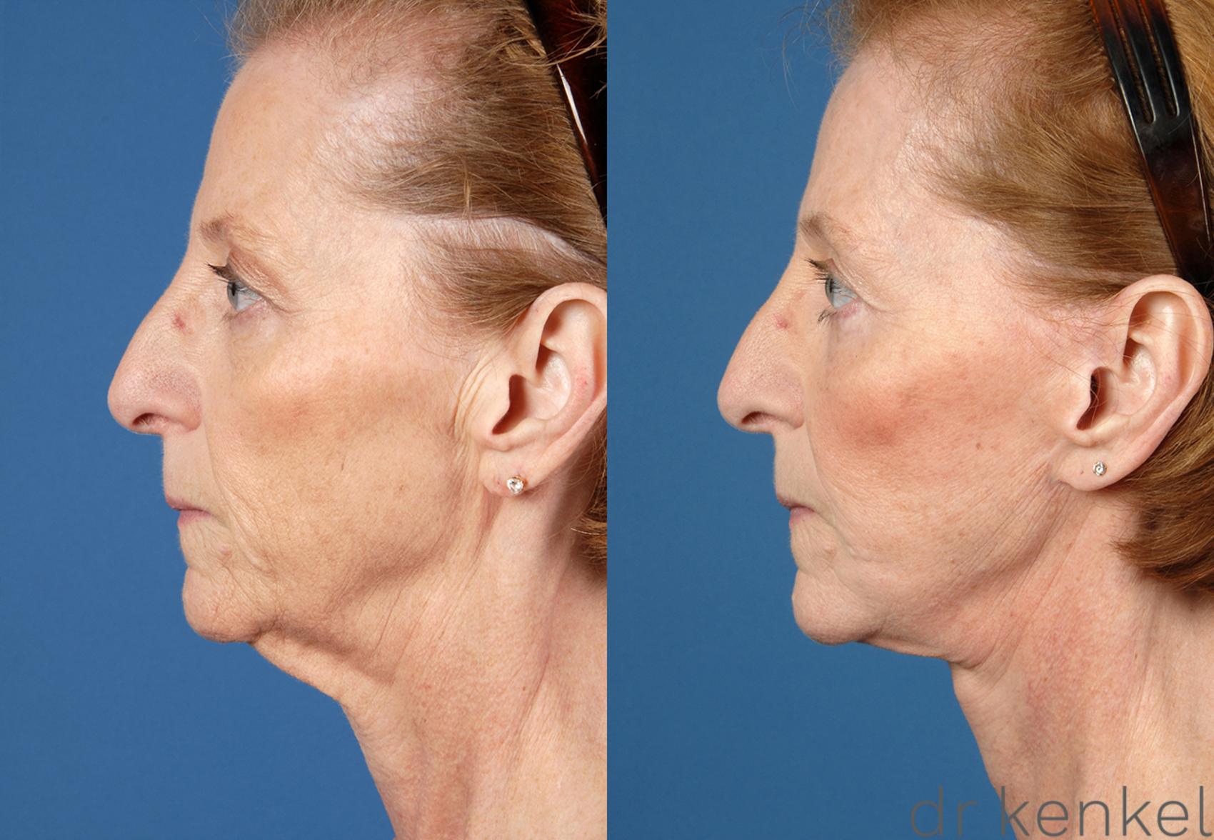 Before & After Facelift Case 52 View #3 View in Dallas, TX