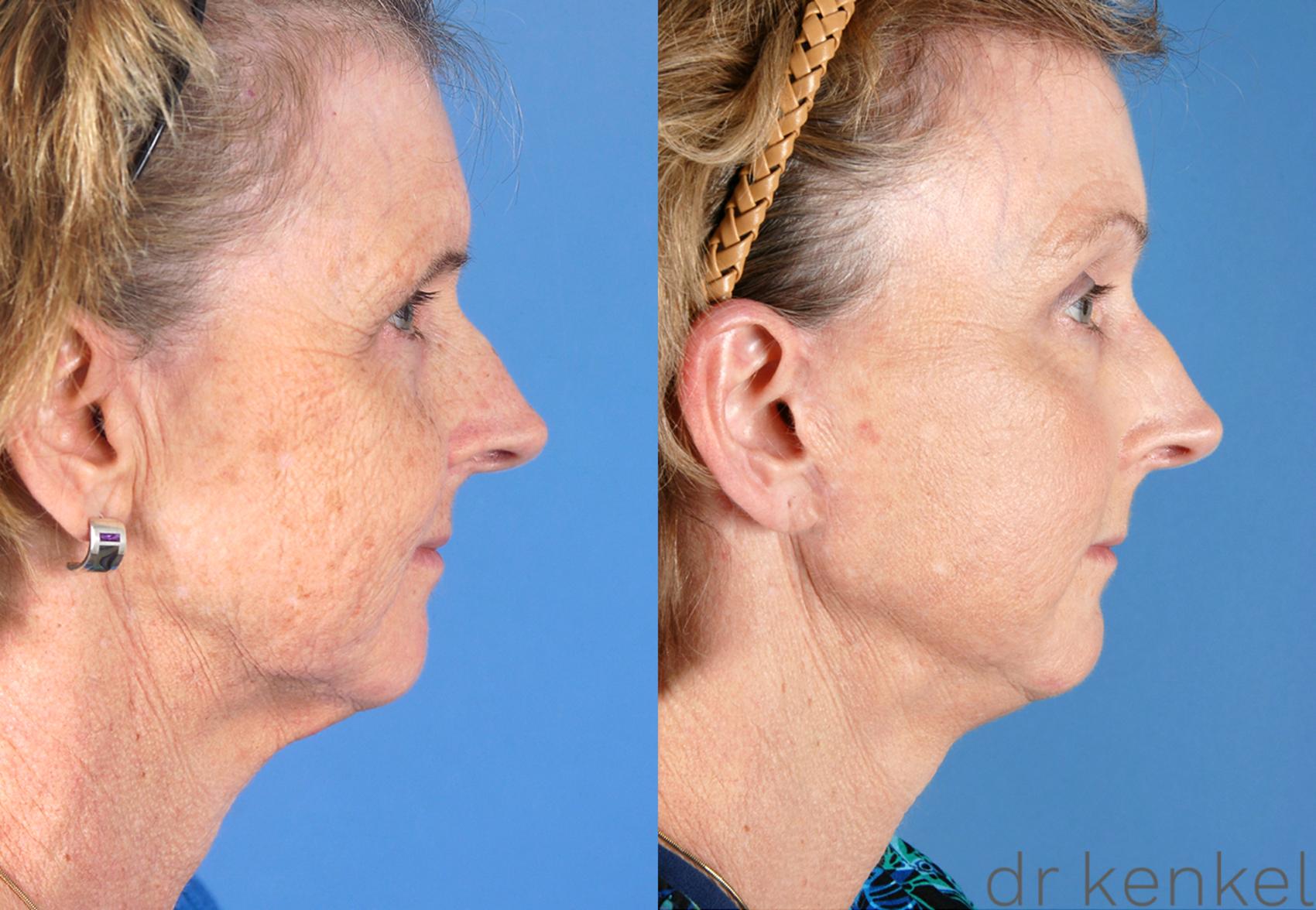 Before & After Facelift Case 55 View #1 View in Dallas, TX