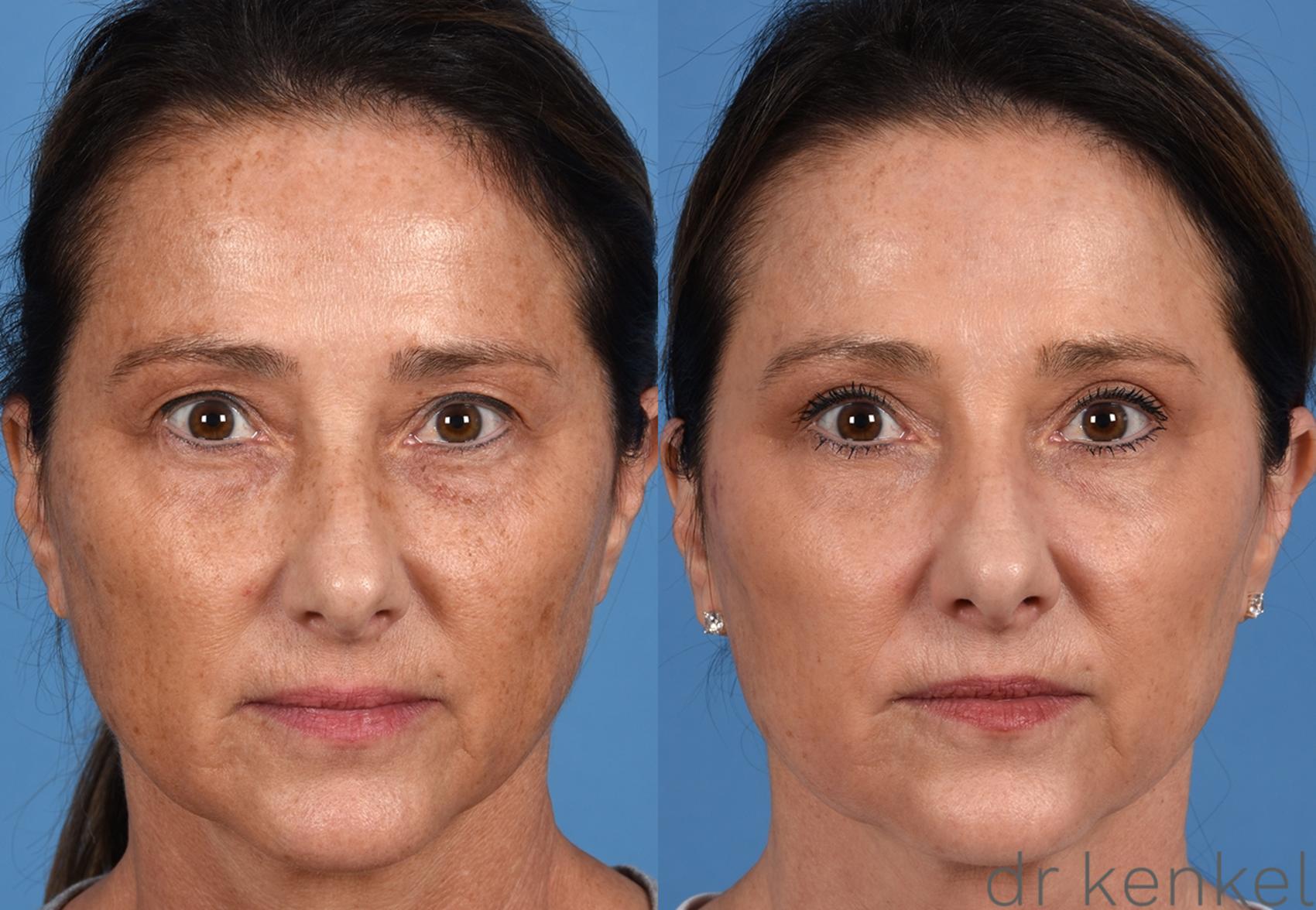 Before & After Facial Rejuvenation Case 375 Front View in Dallas, Frisco, McKinney, Prosper, Allen, Celina, Denton, Anna, TX