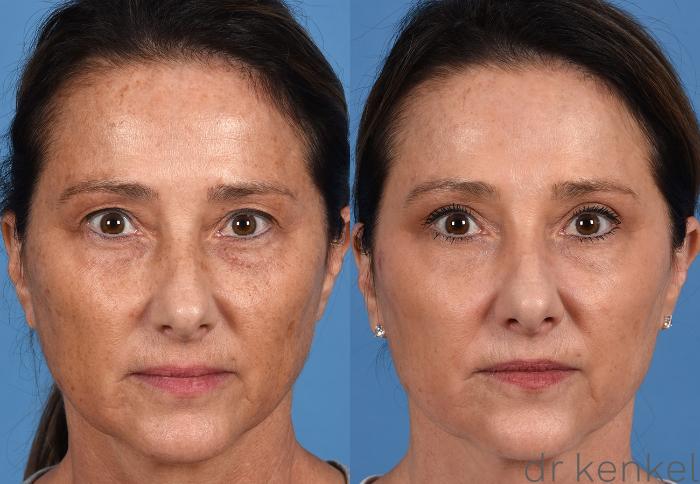 Before & After Facial Rejuvenation Case 375 Front View in Dallas, Frisco, McKinney, Prosper, Allen, Celina, Denton, Anna, TX