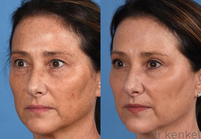 Before & After Facial Rejuvenation Case 375 Left Oblique View in Dallas, Frisco, McKinney, Prosper, Allen, Celina, Denton, Anna, TX