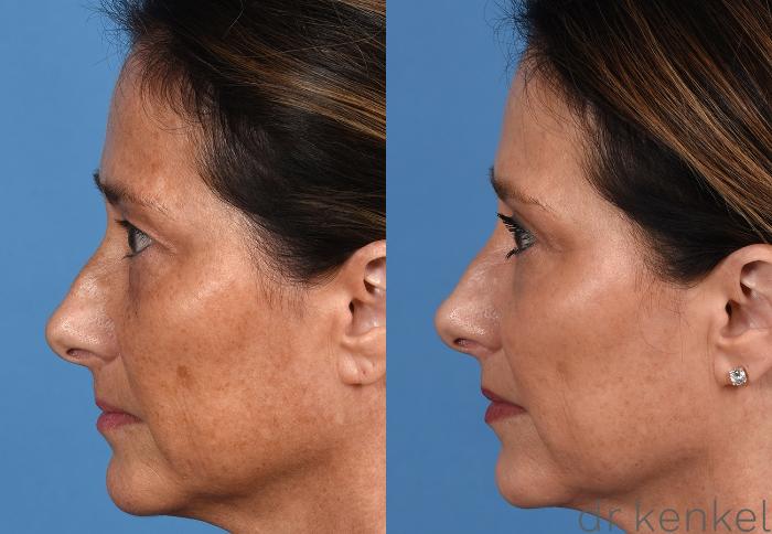 Before & After Facial Rejuvenation Case 375 Left Side View in Dallas, Frisco, McKinney, Prosper, Allen, Celina, Denton, Anna, TX