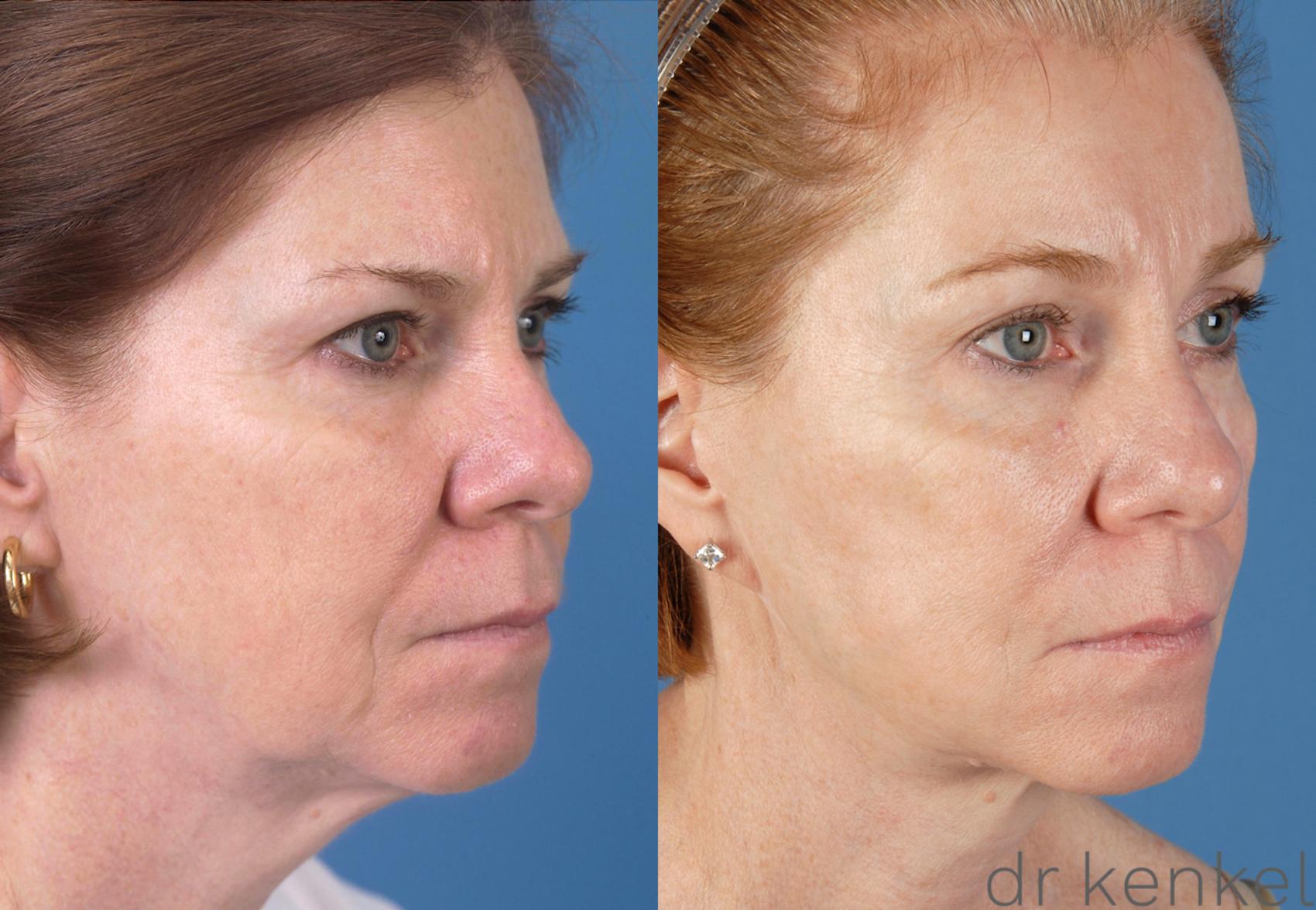 Before & After Facial Rejuvenation Case 49 View #1 View in Dallas, TX