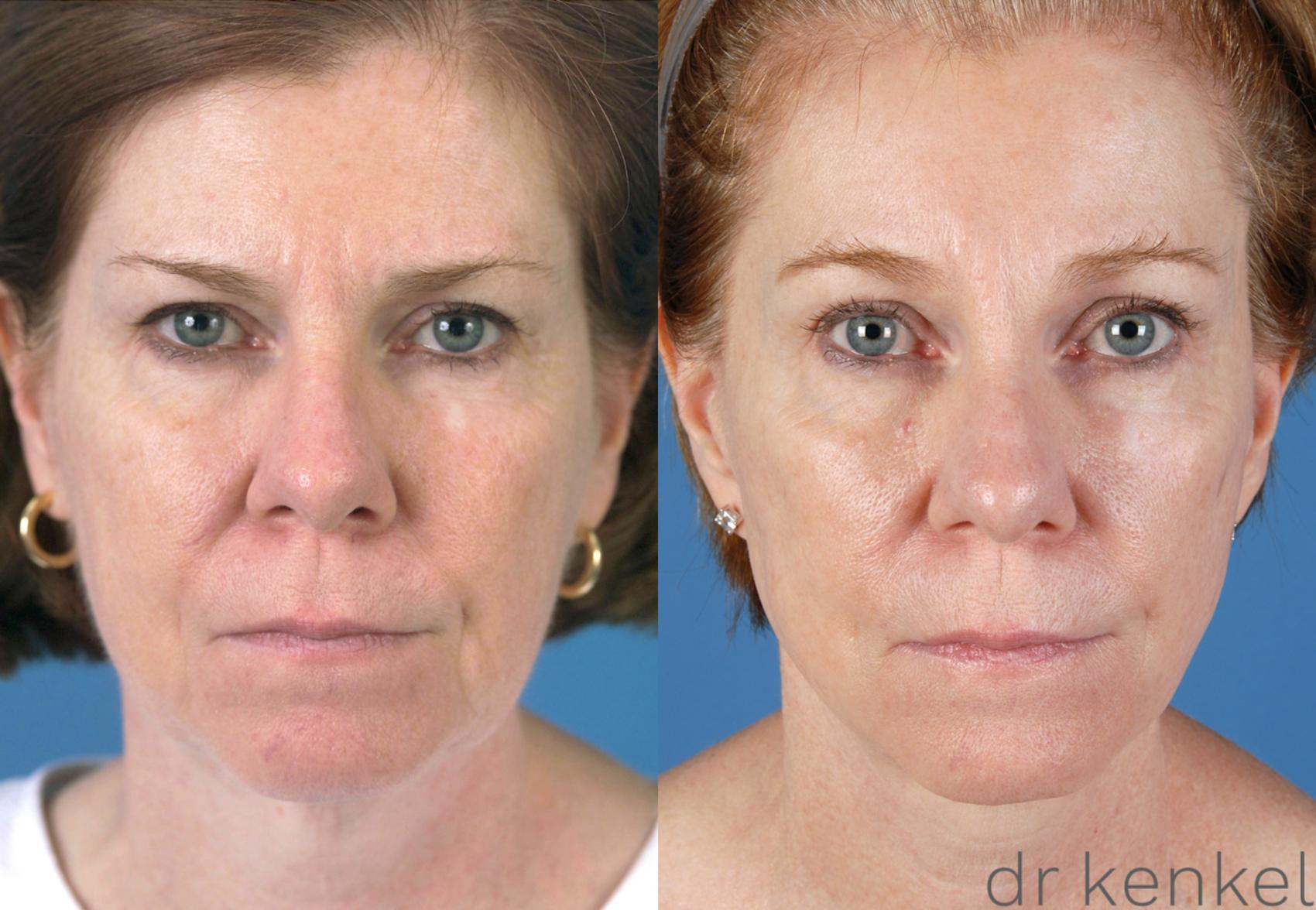 Before & After Facial Rejuvenation Case 49 View #2 View in Dallas, TX