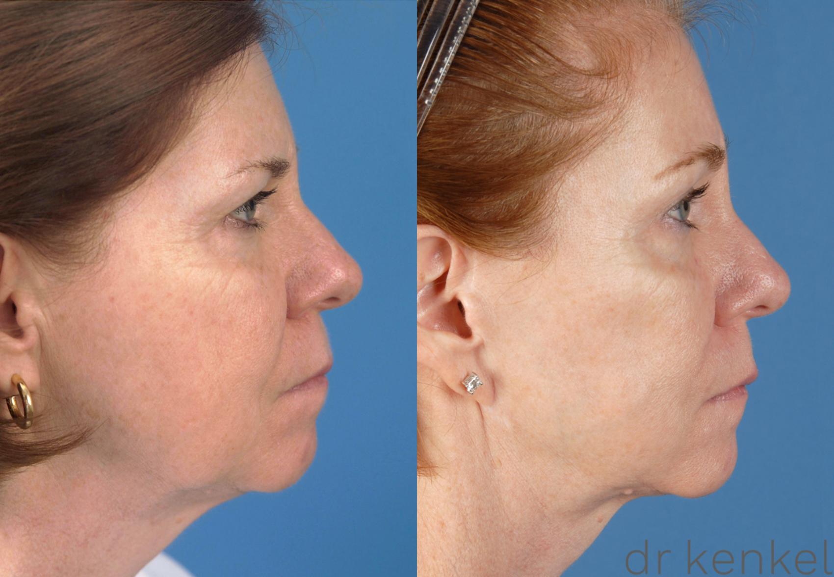 Before & After Facial Rejuvenation Case 49 View #3 View in Dallas, TX