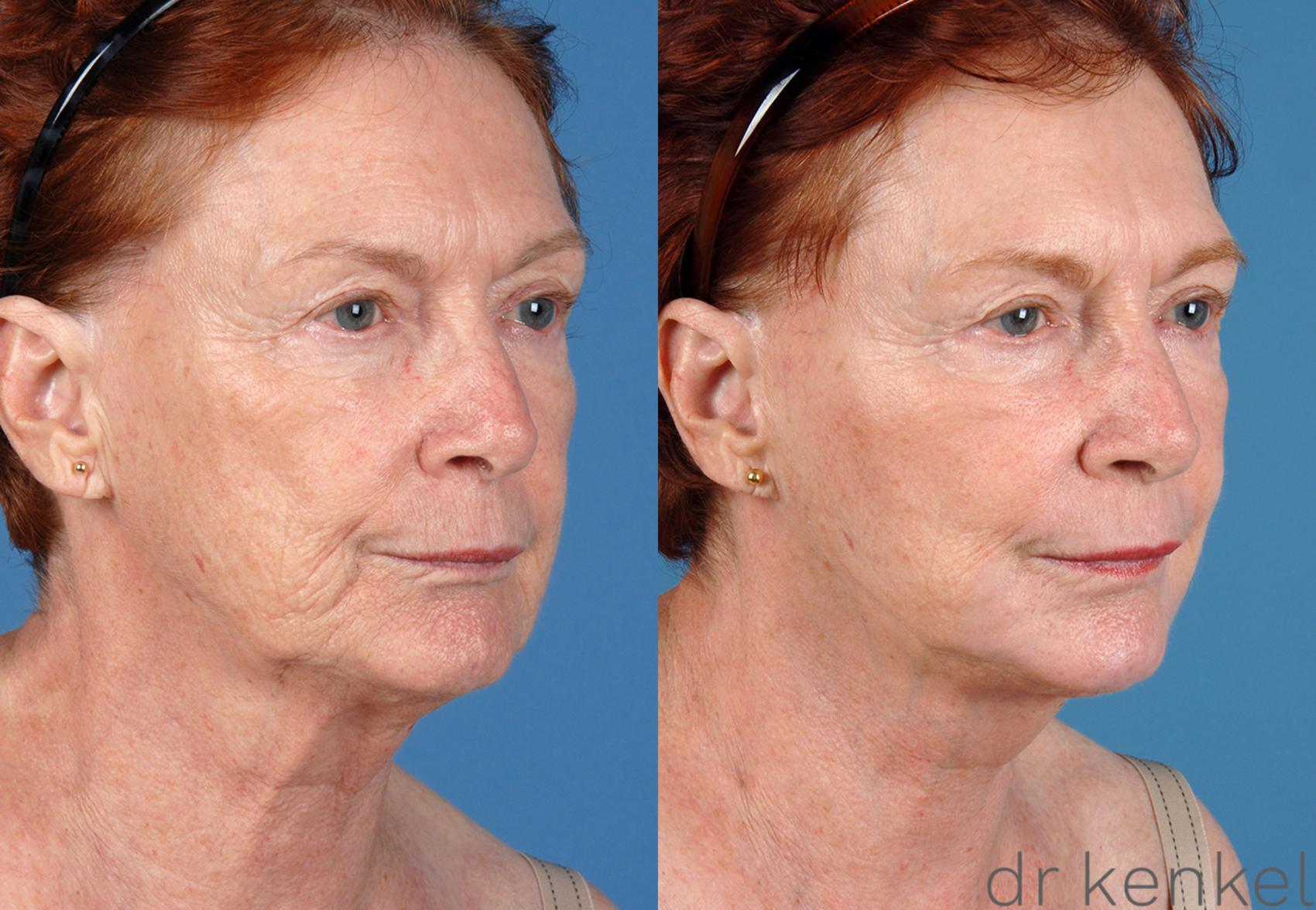 Before & After Eyelid Surgery Case 53 View #1 View in Dallas, TX