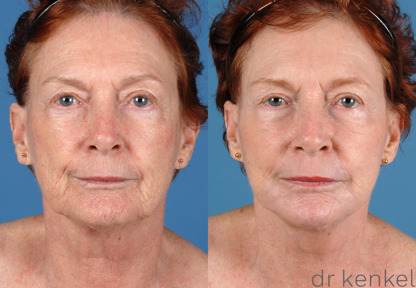 Before & After Facial Rejuvenation Case 53 View #2 View in Dallas, TX