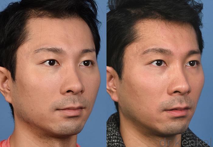 Before & After Nonsurgical for Men Case 377 Right Oblique View in Dallas, Frisco, McKinney, Prosper, Allen, Celina, Denton, Anna, TX