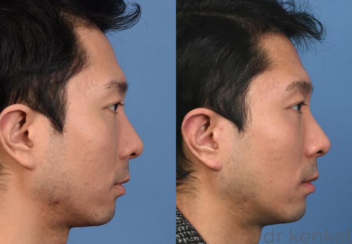 Before & After Nonsurgical for Men Case 377 Right Side View in Dallas, Frisco, McKinney, Prosper, Allen, Celina, Denton, Anna, TX