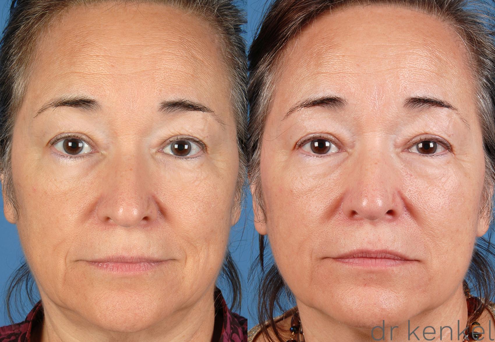 Before & After Injectables Case 17 View #1 View in Dallas, TX