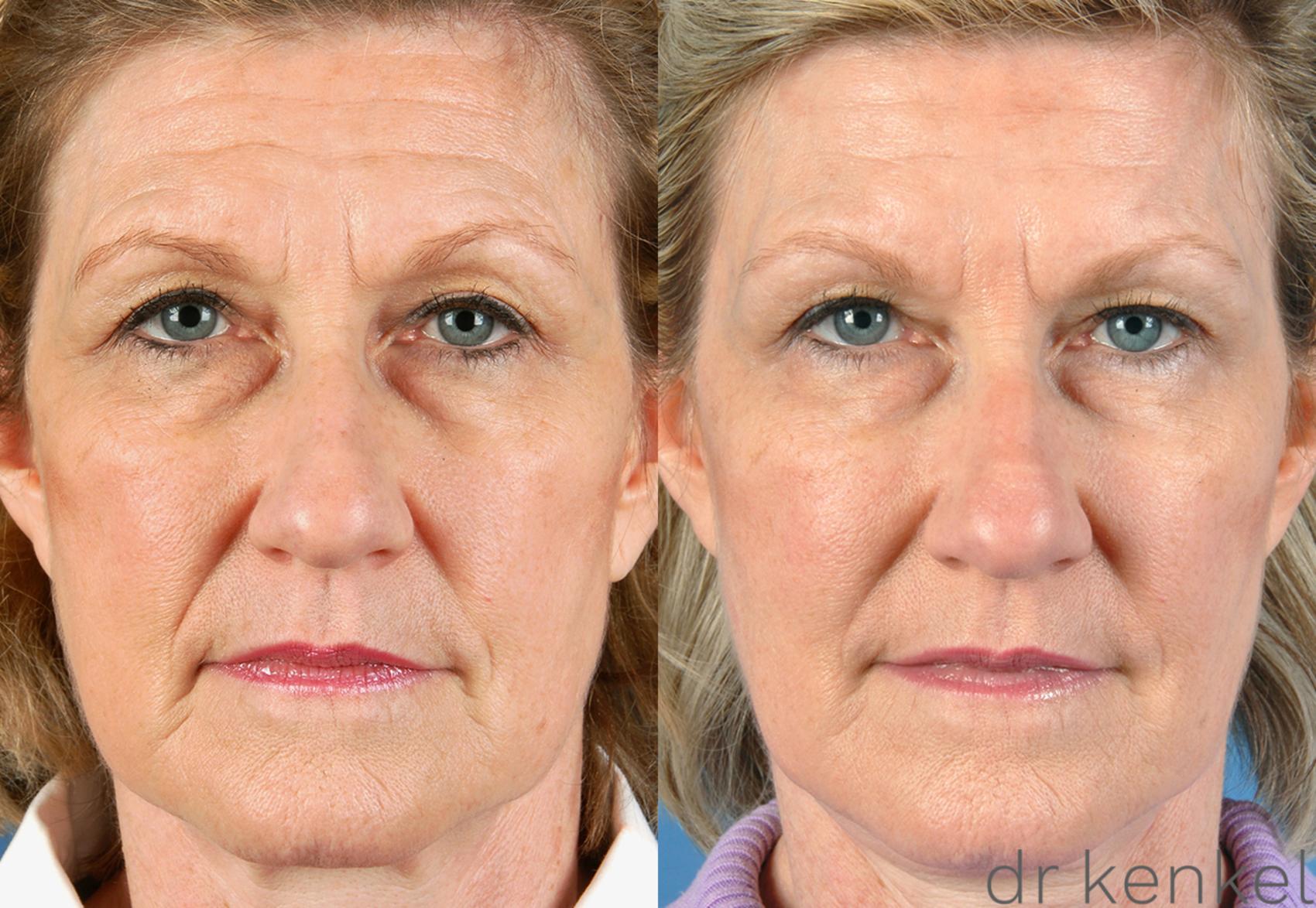 Before & After Injectables Case 18 View #1 View in Dallas, Frisco, McKinney, Prosper, Allen, Celina, Denton, Anna, TX