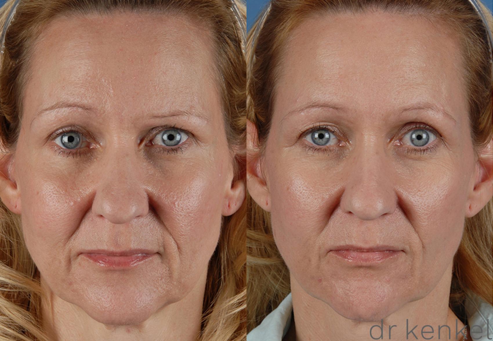 Before & After Injectables Case 190 View #1 View in Dallas, TX