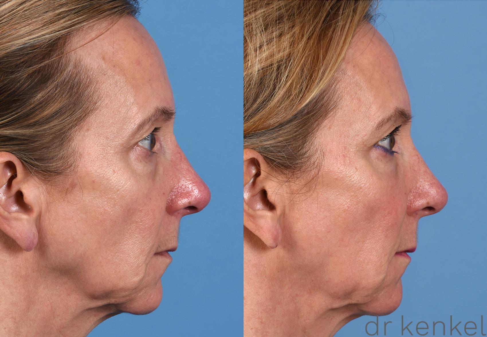 Injectable Fillers Case 316 