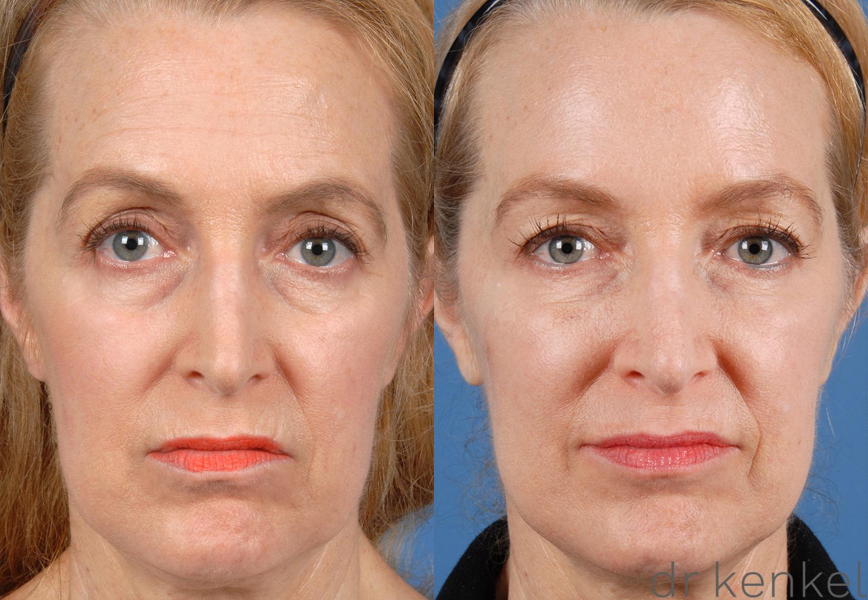 Before & After Injectables Case 74 View #1 View in Dallas, TX