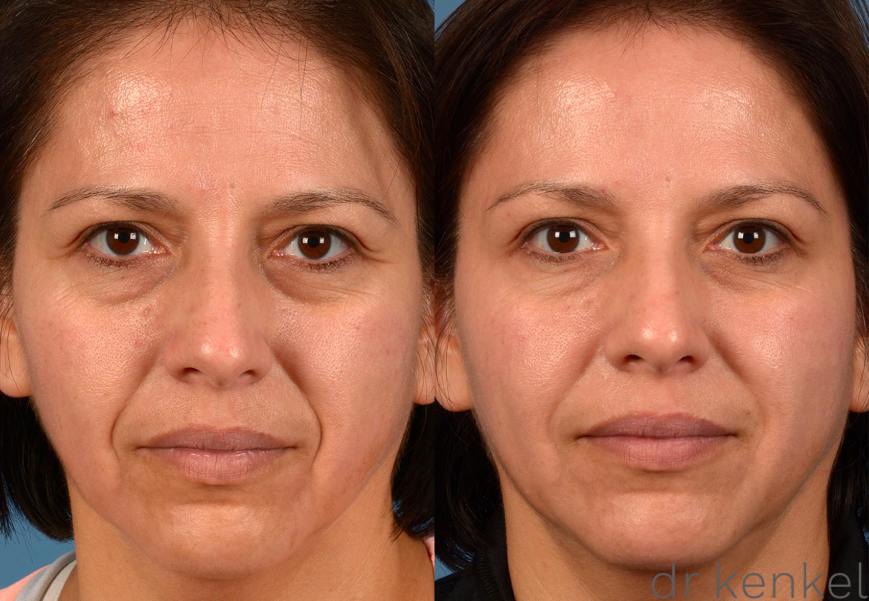 Before & After Injectables Case 75 View #1 View in Dallas, TX