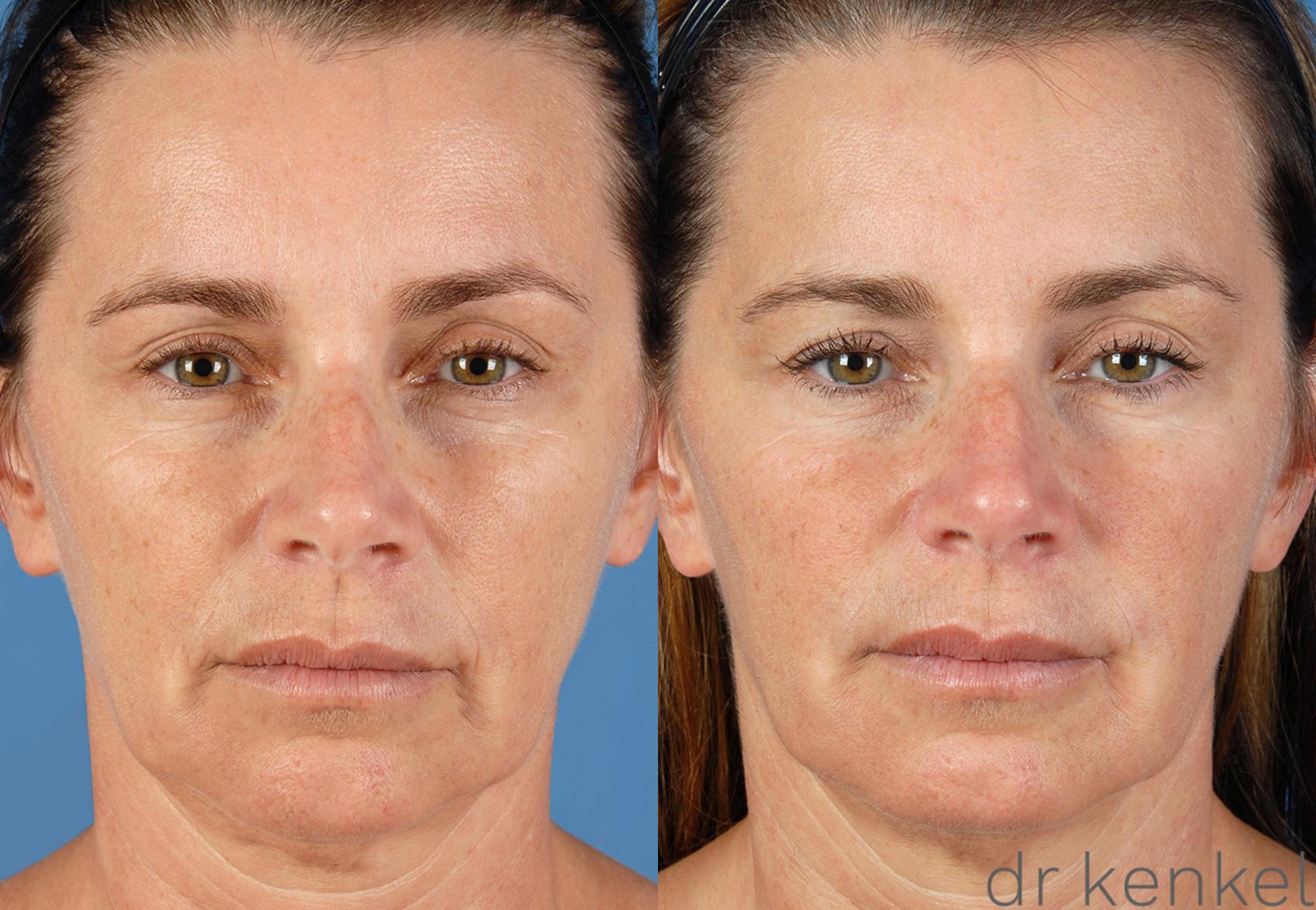 Before & After Injectables Case 77 View #1 View in Dallas, TX