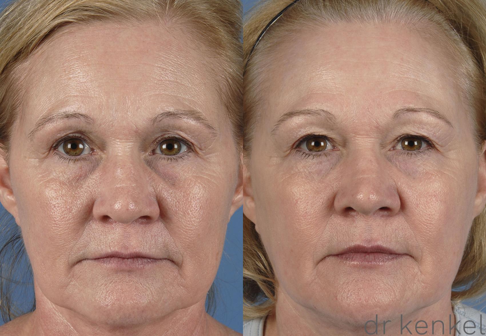 Before & After Laser Skin Resurfacing Case 155 View #1 View in Dallas, Frisco, Fort Worth, McKinney, Prosper, Allen, Celina, Denton, Anna, TX