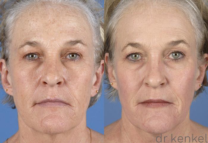 Before & After Laser Skin Resurfacing Case 249 View #1 View in Dallas, Frisco, McKinney, Prosper, Allen, Celina, Denton, Anna, TX