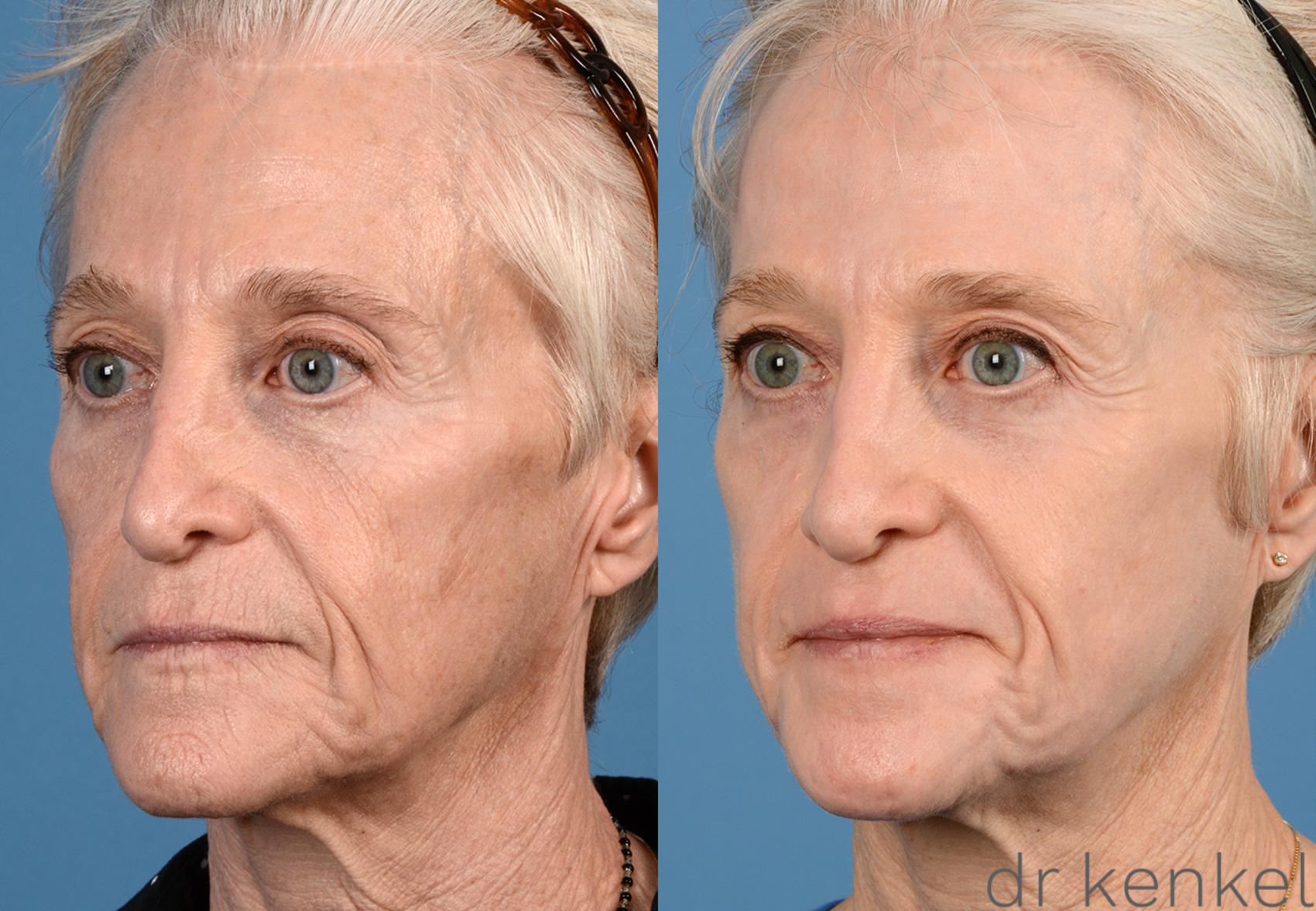 Before & After Laser Skin Resurfacing Case 296 View #2 View in Dallas, Frisco, McKinney, Prosper, Allen, Celina, Denton, Anna, TX