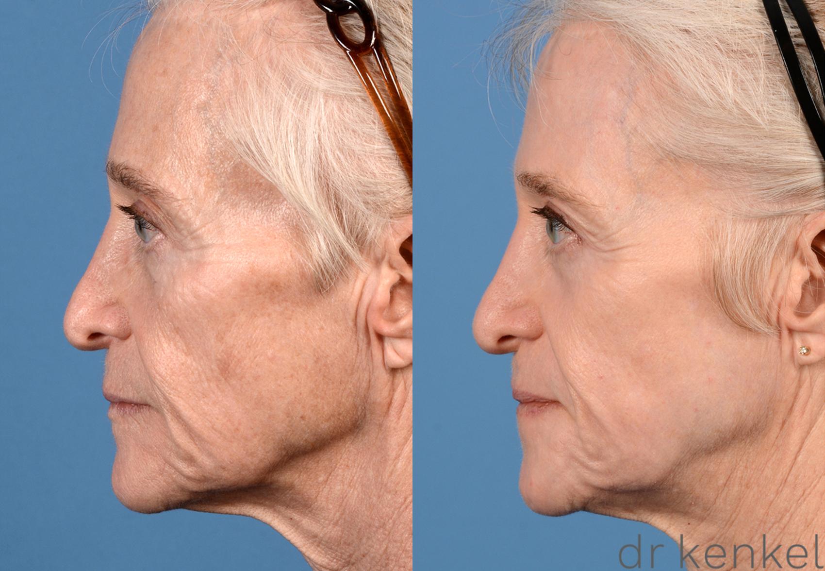 Before & After Laser Skin Resurfacing Case 296 View #3 View in Dallas, Frisco, McKinney, Prosper, Allen, Celina, Denton, Anna, TX