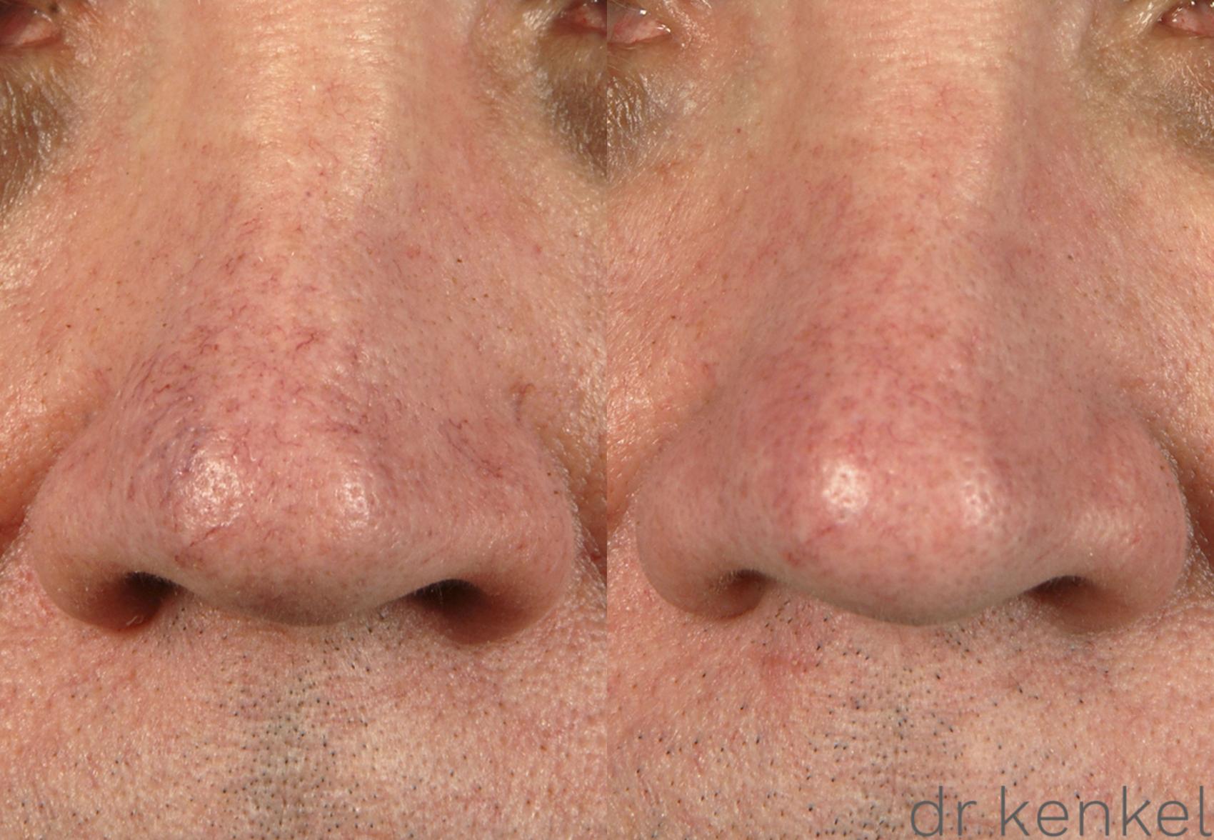 Before & After Laser Treatments Case 148 View #1 View in Dallas, TX