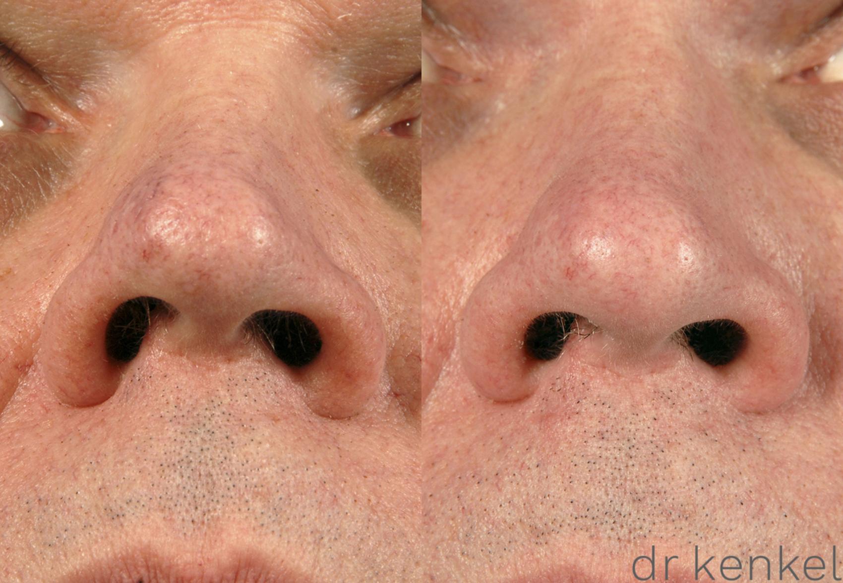 Before & After Laser Treatments Case 148 View #2 View in Dallas, TX