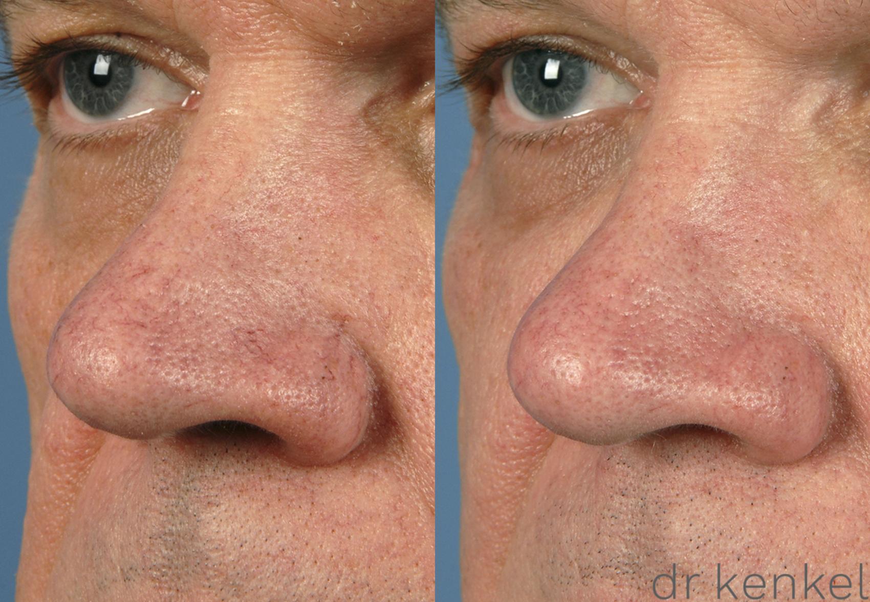 Before & After Laser Treatments Case 148 View #3 View in Dallas, TX