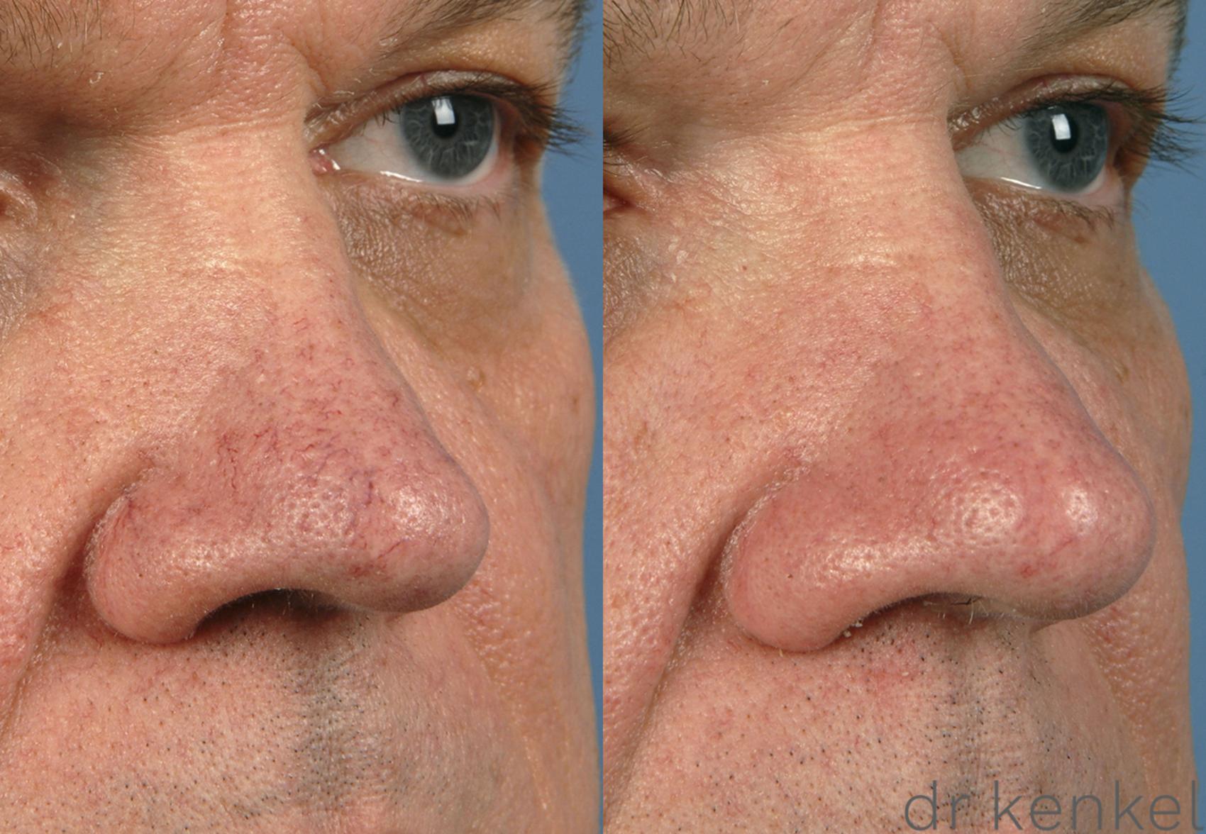 Before & After Laser Treatments Case 148 View #4 View in Dallas, TX