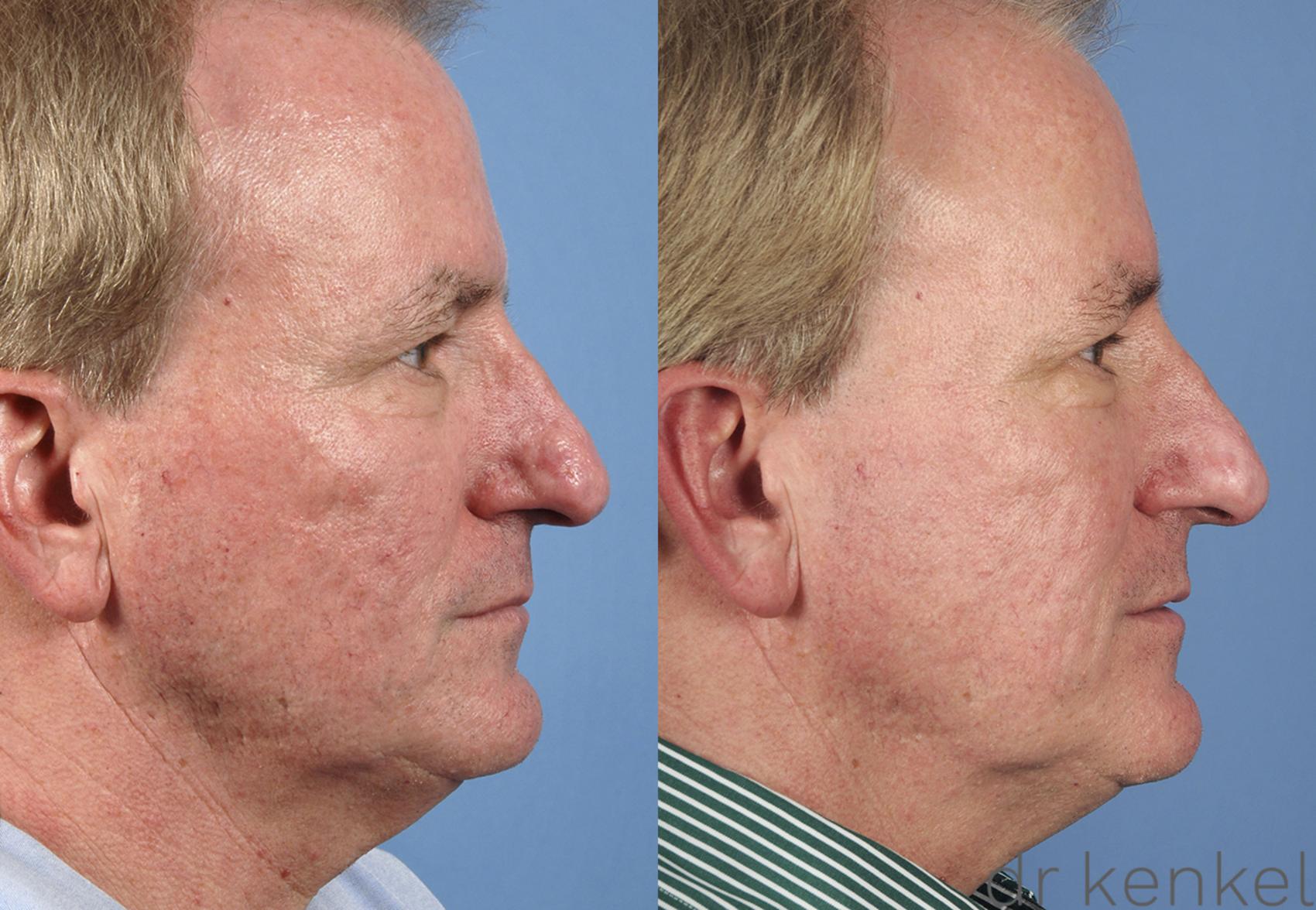 Before & After Laser Treatments Case 159 View #2 View in Dallas, Frisco, McKinney, Prosper, Allen, Celina, Denton, Anna, TX