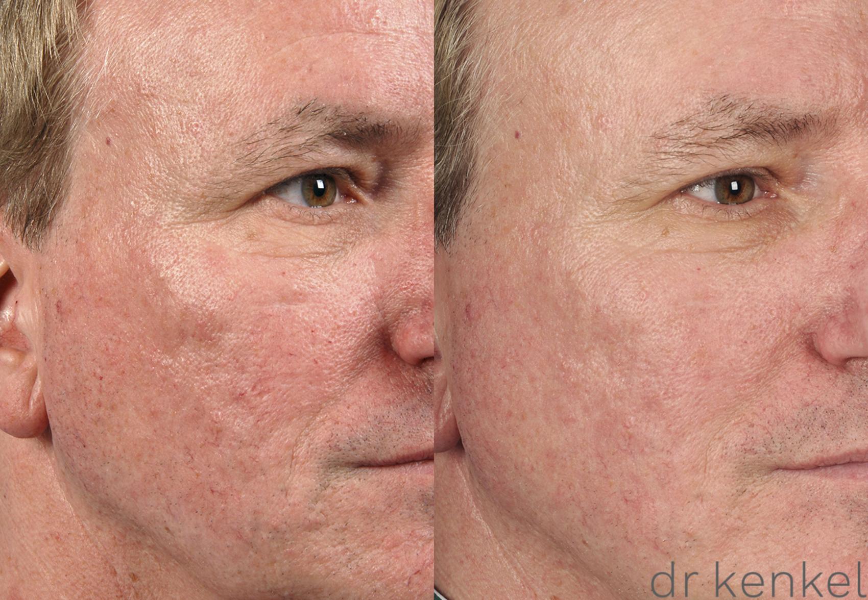 Before & After Laser Treatments Case 159 View #3 View in Dallas, Frisco, McKinney, Prosper, Allen, Celina, Denton, Anna, TX