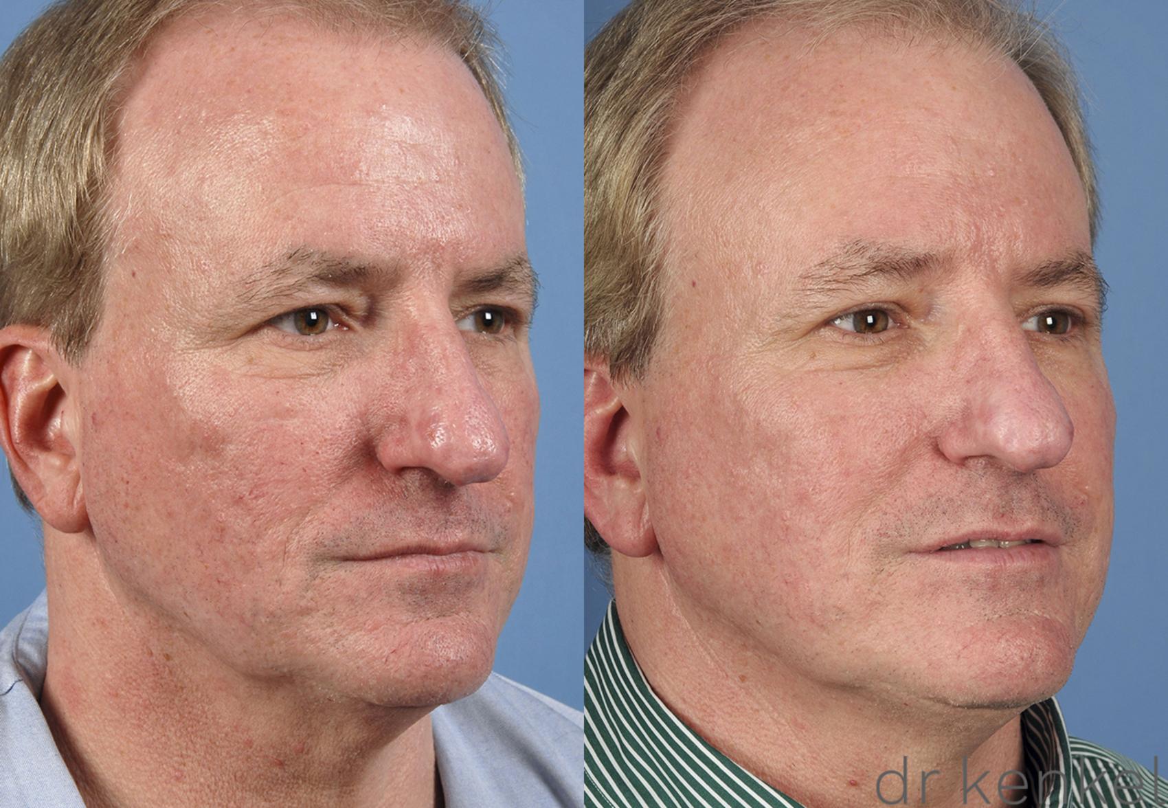 Before & After Laser Treatments Case 159 View #4 View in Dallas, Frisco, McKinney, Prosper, Allen, Celina, Denton, Anna, TX