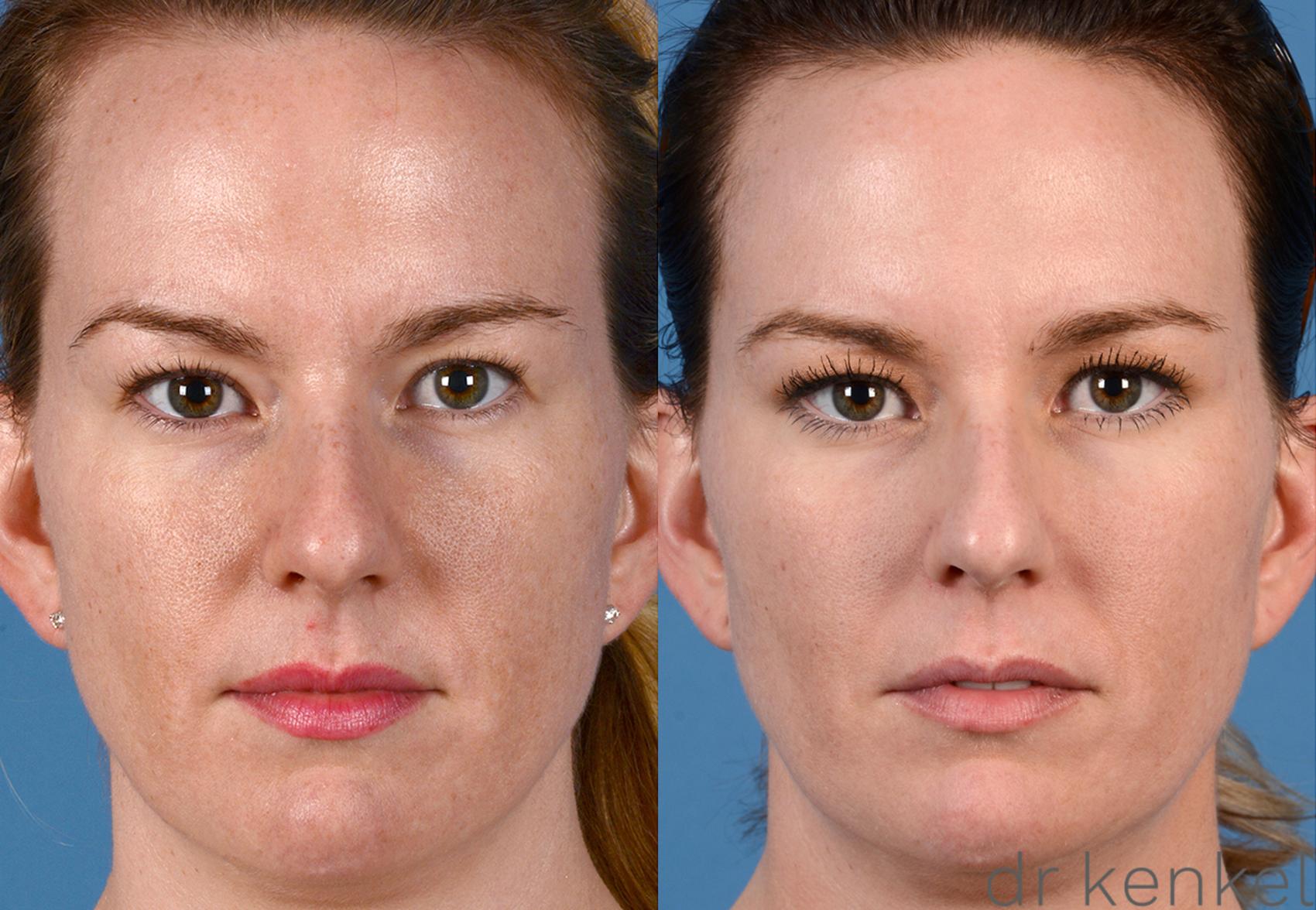 Before & After Laser Treatments Case 258 View #1 View in Dallas, Frisco, McKinney, Prosper, Allen, Celina, Denton, Anna, TX