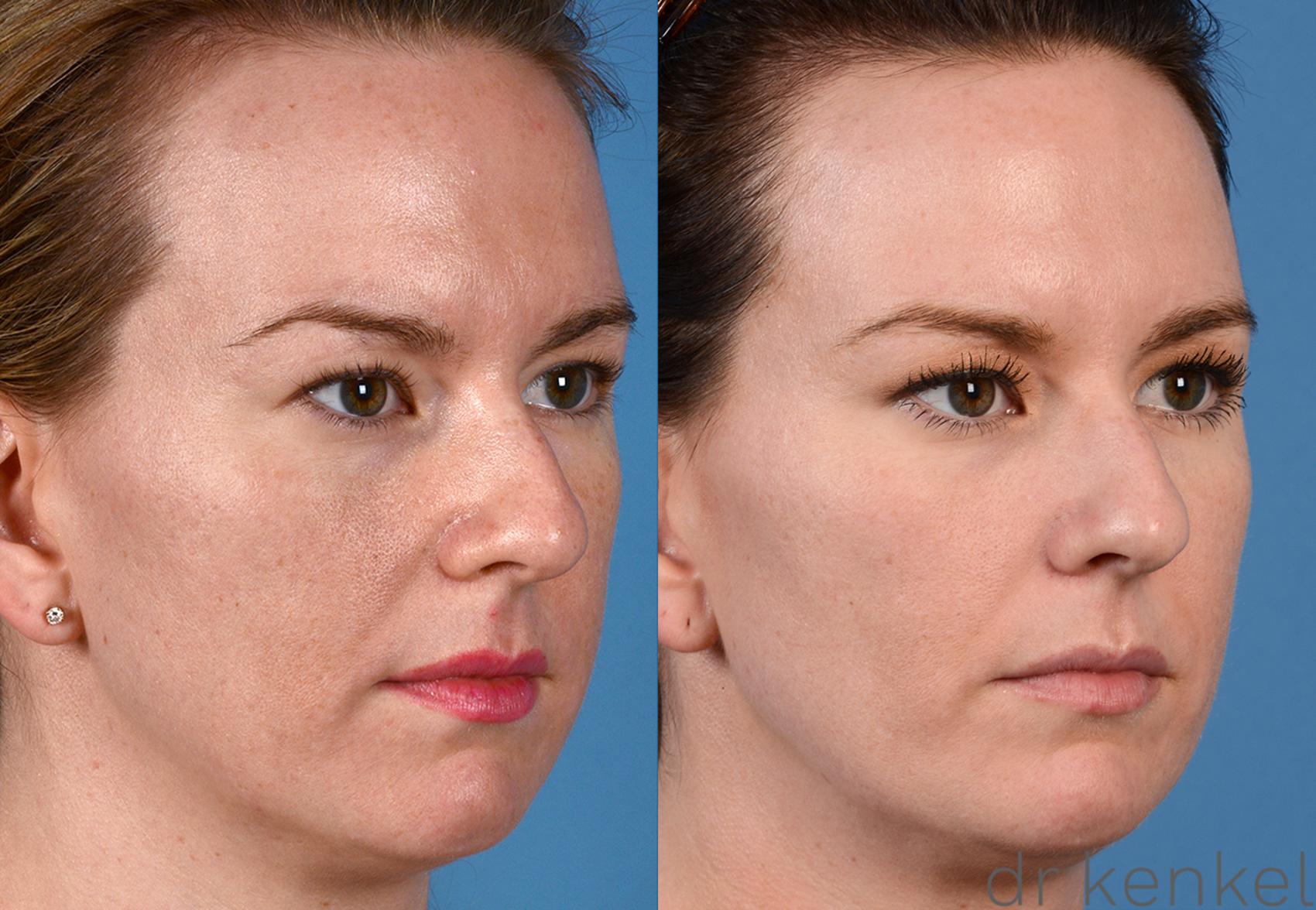 Before & After Laser Treatments Case 258 View #2 View in Dallas, TX