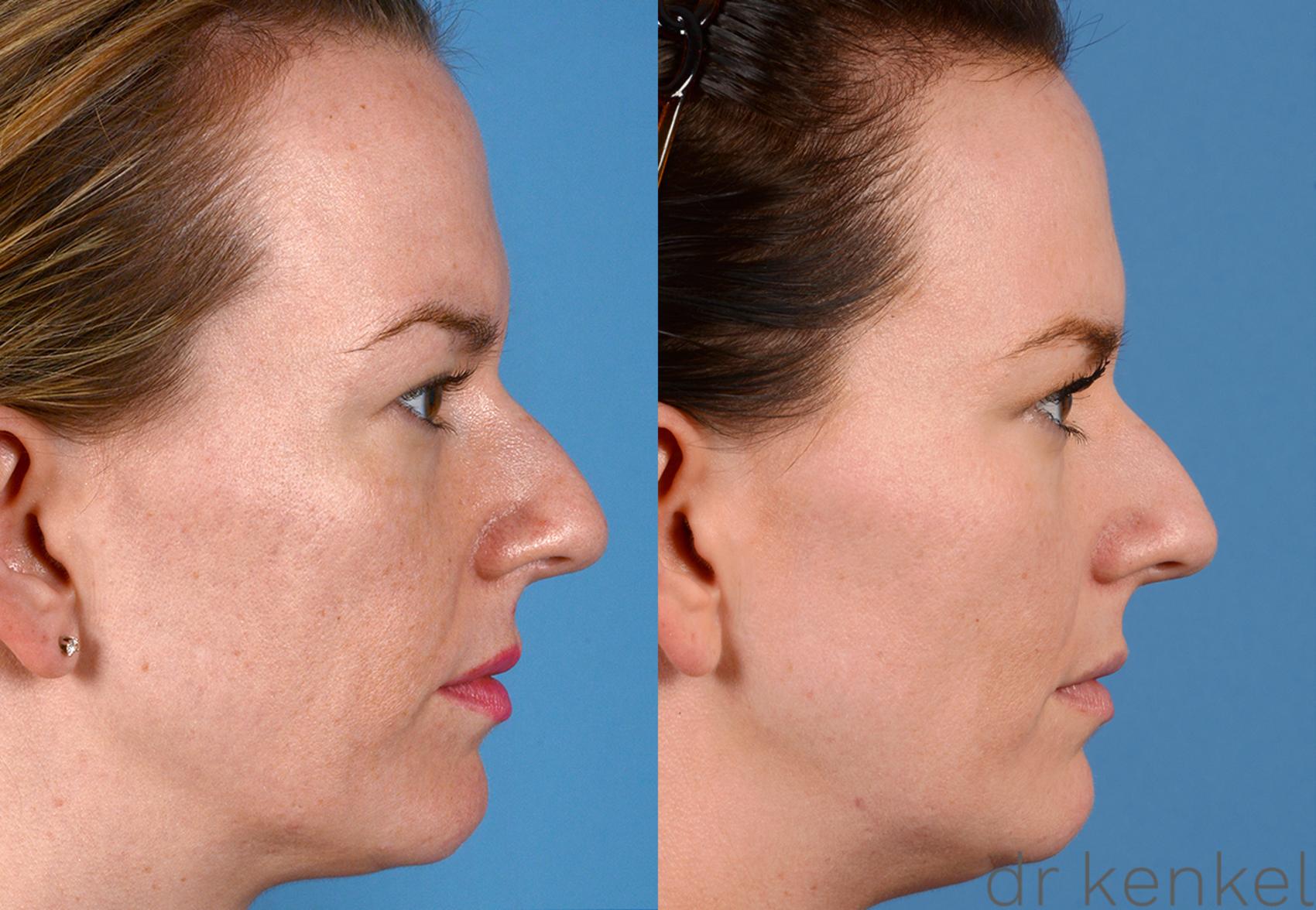Before & After Laser Treatments Case 258 View #3 View in Dallas, TX