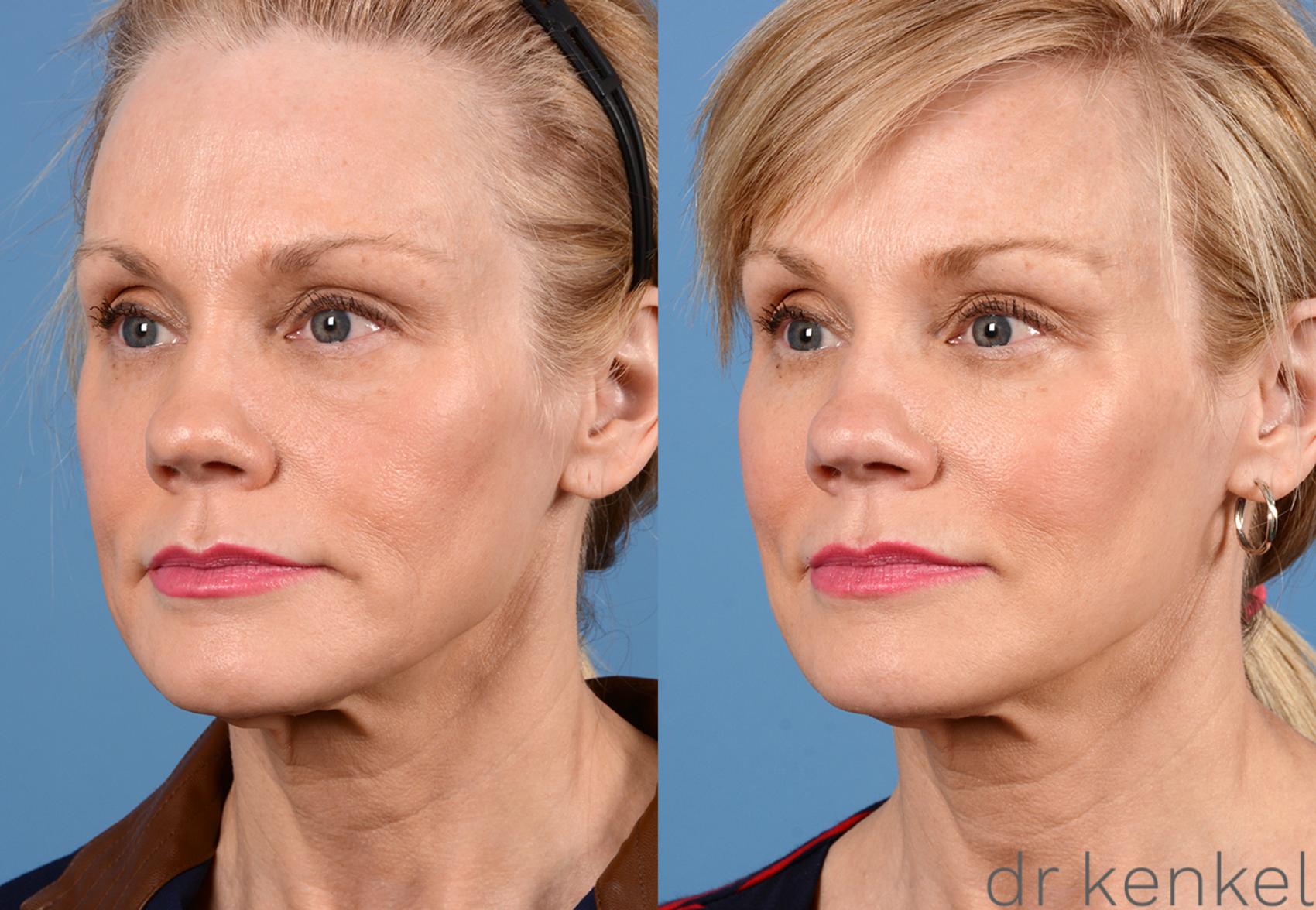 Before & After Laser Treatments Case 298 View #2 View in Dallas, TX