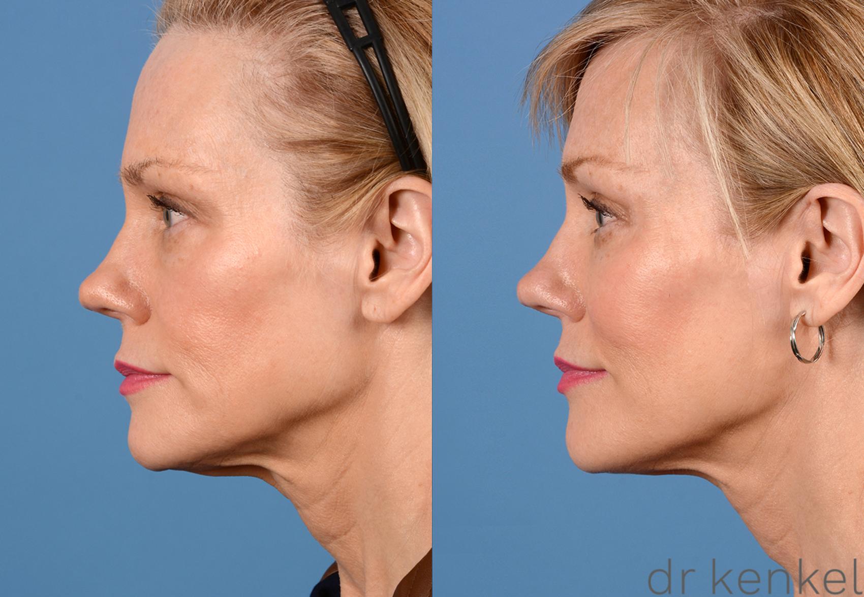 Before & After Laser Treatments Case 298 View #3 View in Dallas, TX