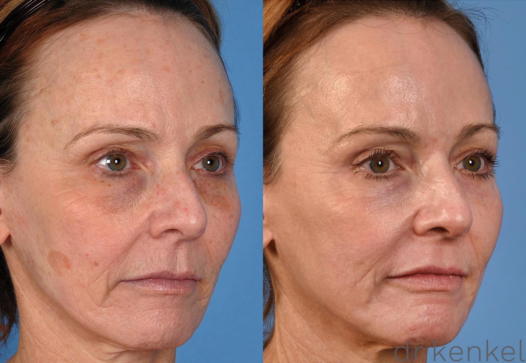 Before & After Laser Treatments Case 313 View #2 View in Dallas, Frisco, McKinney, Prosper, Allen, Celina, Denton, Anna, TX