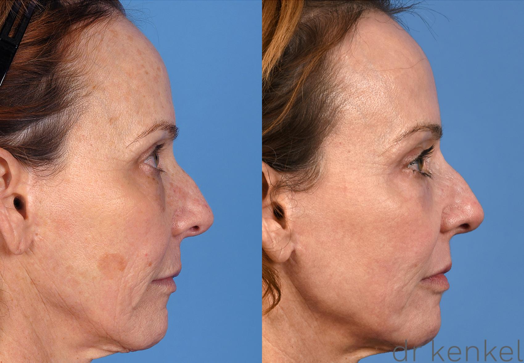 Before & After Laser Treatments Case 313 View #3 View in Dallas, Frisco, McKinney, Prosper, Allen, Celina, Denton, Anna, TX