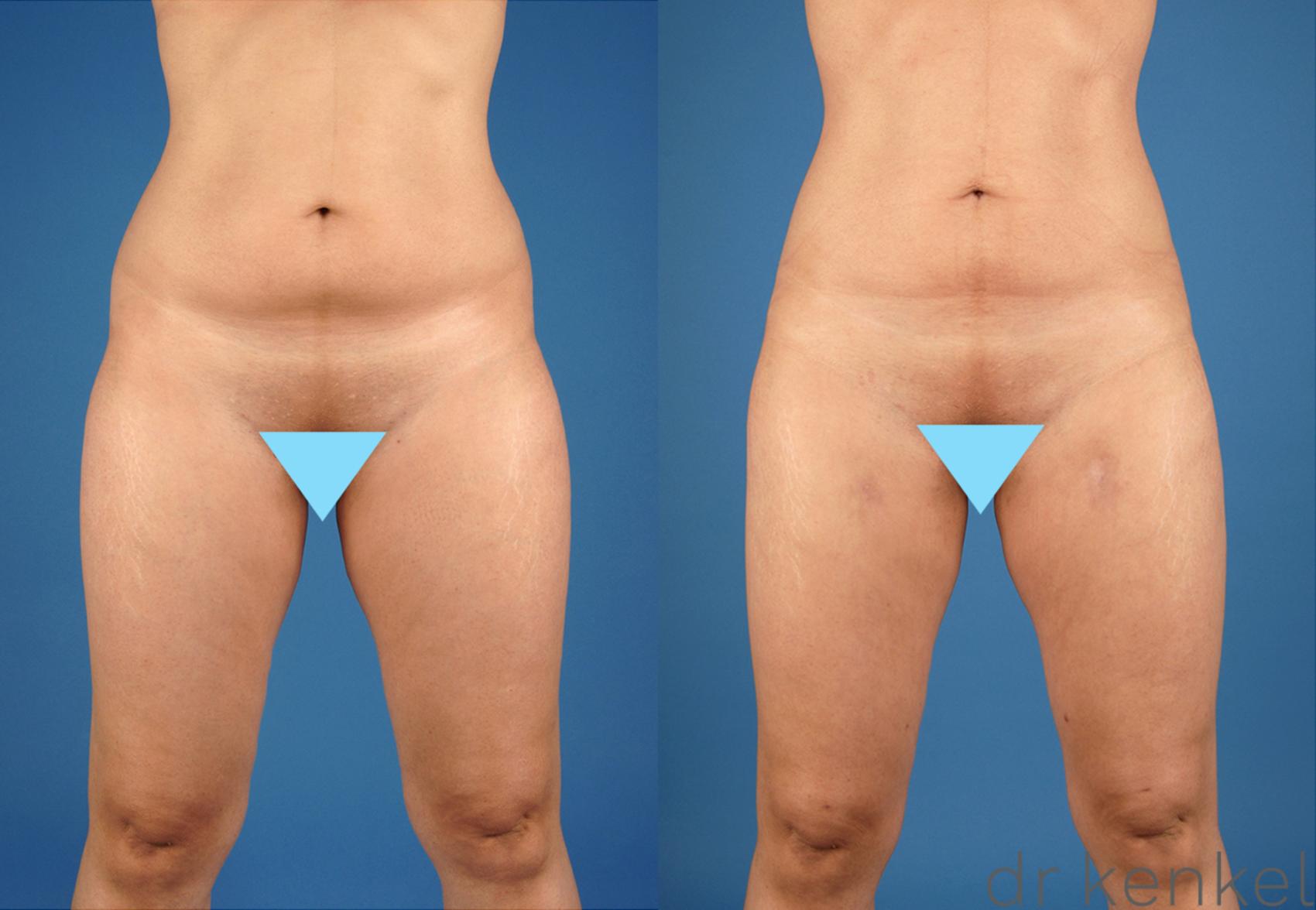 Before & After Liposuction Case 218 View #1 View in Dallas, TX