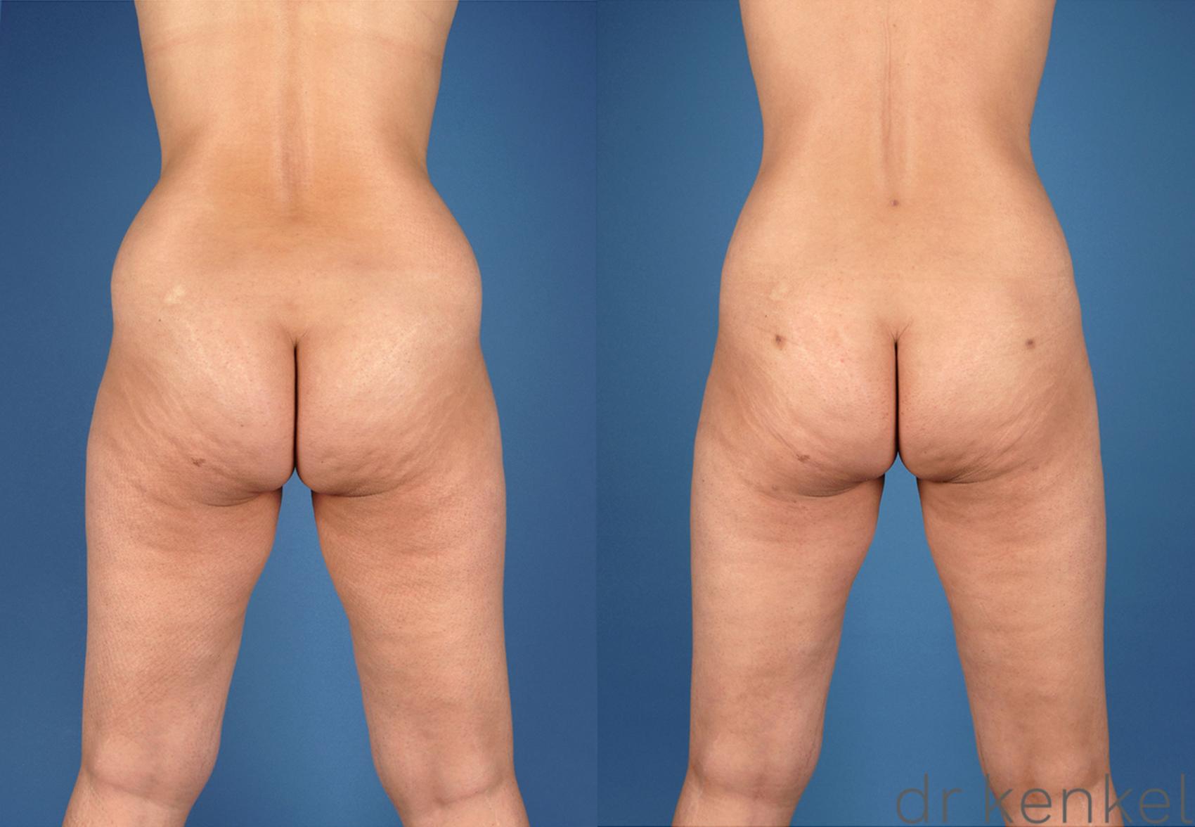 Before & After Liposuction Case 218 View #2 View in Dallas, TX