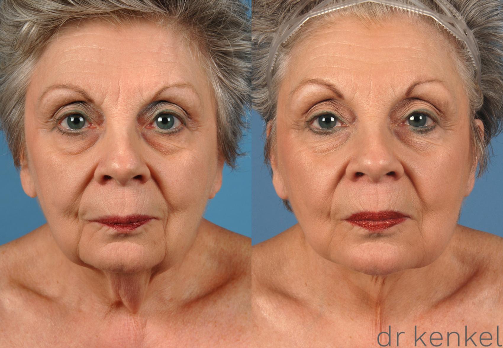 Before & After Neck Lift Case 147 View #1 View in Dallas, TX